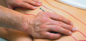 Akupunktmassage